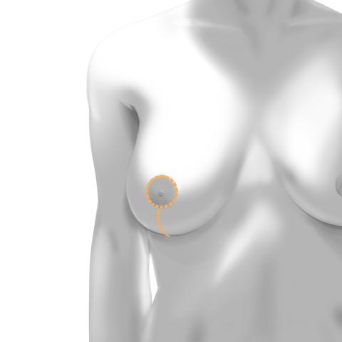 Breast lift keyhole incision