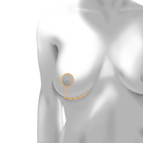 Breast Lift anchor incision