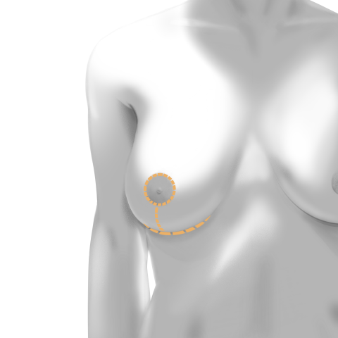 Breast Reduction Incisions & Scars