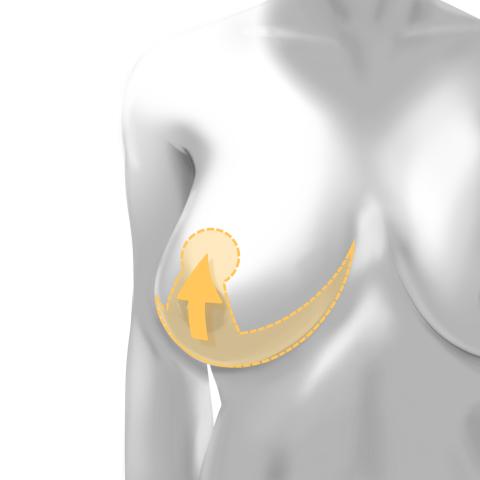 Breast reduction incision