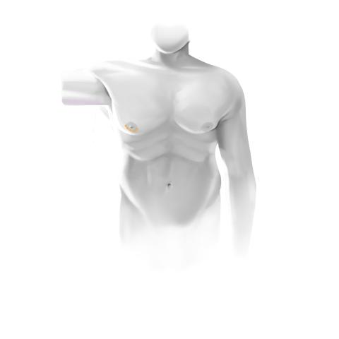 Gynecomastia surgery