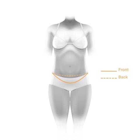 Lower body lift incision - front