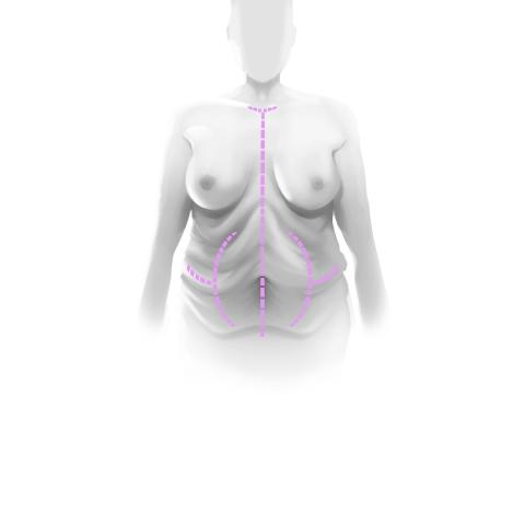 Multiple incisions post-bariatric surgery
