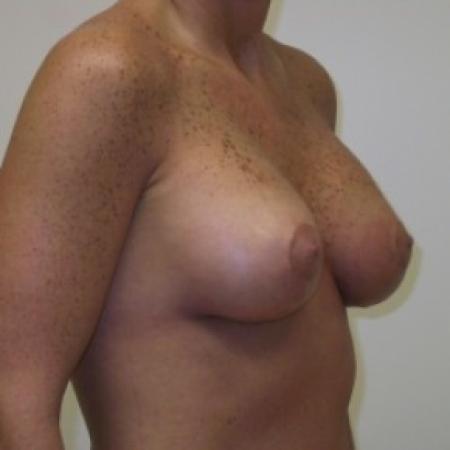 After image 3 Case #81116 - Breast Lift with Saline Filled Implants