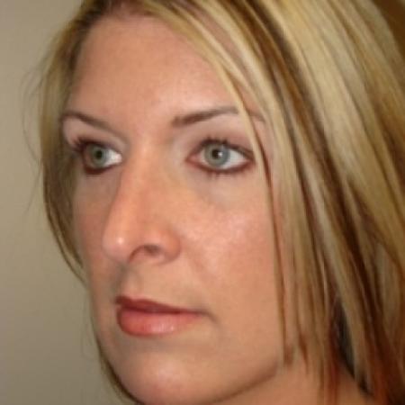 After image 4 Case #79536 - Rhinoplasty