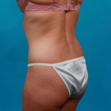 After image 4 Case #78946 - Tummy Tuck & Flank Lipo