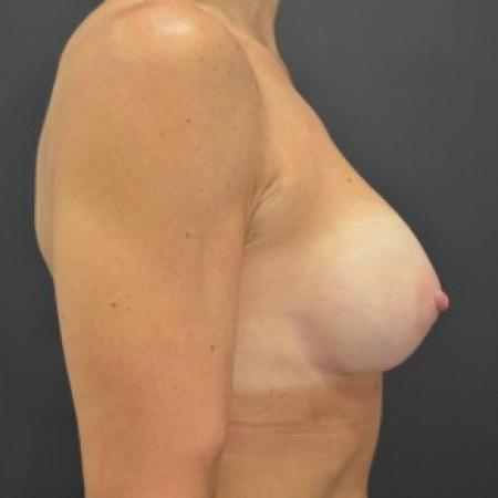 After image 3 Case #85781 - Breast Augmentation 