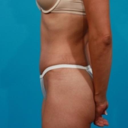 After image 3 Case #78906 - Tummy Tuck