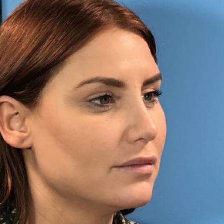 After image 2 Case #87356 - 27 year-old  -  Rhinoplasty/Septoplasty/Turbinectomy/Liposuction to Neck  -  2 months post-op