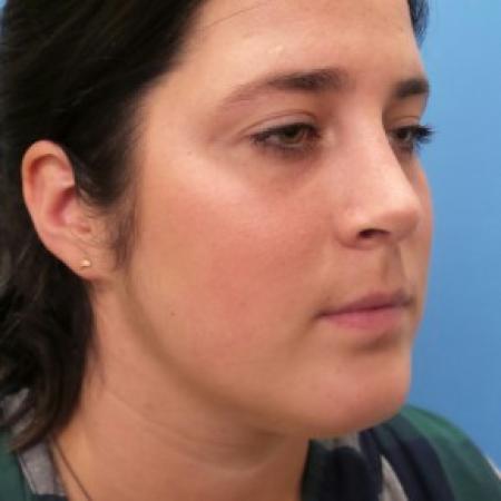 After image 2 Case #86451 - Rhinoplasty/Septoplasty/Turbinectomy
