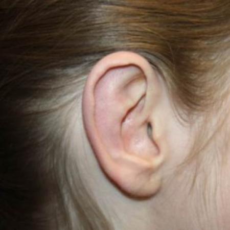 After image 3 Case #84636 - Otoplasty - 17 year old female