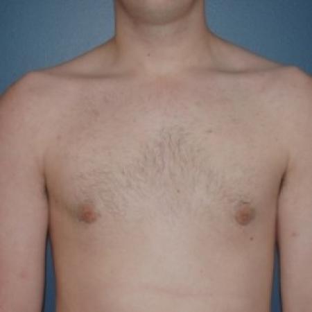 After image 1 Case #81231 - Bilateral gynecomastia