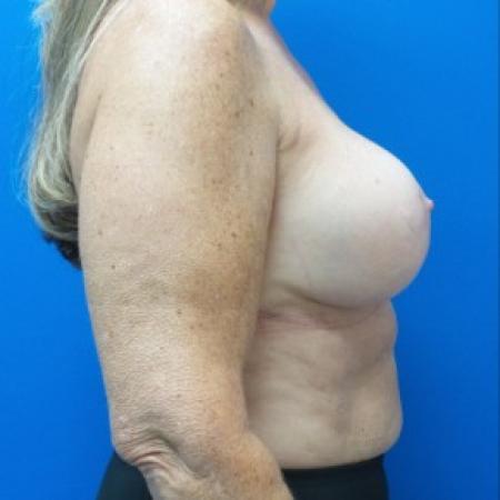 After image 3 Case #87281 - Breast Augmentation Revision