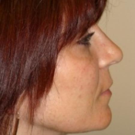 After image 4 Case #79556 - Rhinoplasty
