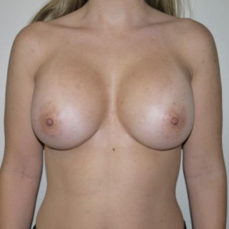 After image 1 Case #82301 - Sub muscular Breast Augmentation