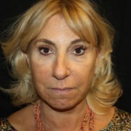 After image 1 Case #85796 - Face-lift, Brow-lift, Necklift - 68 year old female