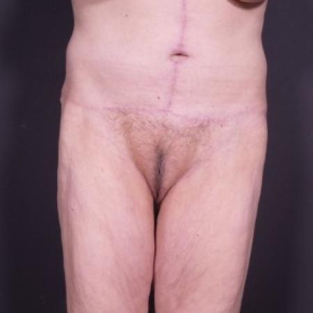 After image 1 Case #85281 - Fleur De Lis Abdominoplasty after Weight Loss