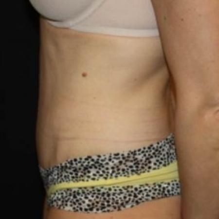 After image 3 Case #84221 - Abdominoplasty, plication of rectus diastasis, ventral hernia repair - 35 year old female