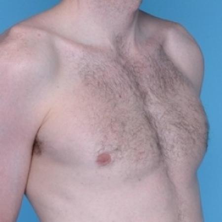 After image 3 Case #79266 - Male Breast Reduction