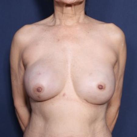 After image 1 Case #83576 - 71 Years Old Female