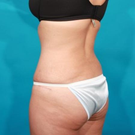 After image 4 Case #84071 - Abdominoplasty with Flank Lipo