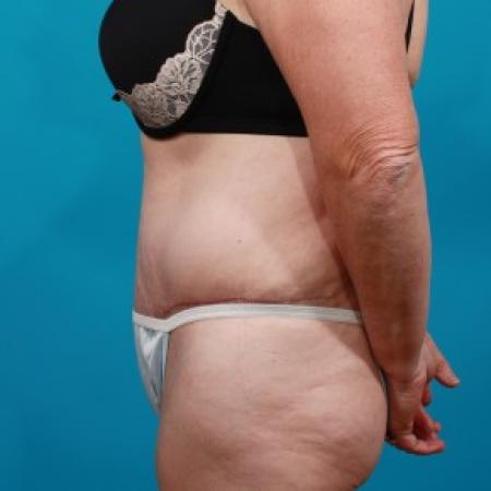 After image 3 Case #84091 - Abdominoplasty