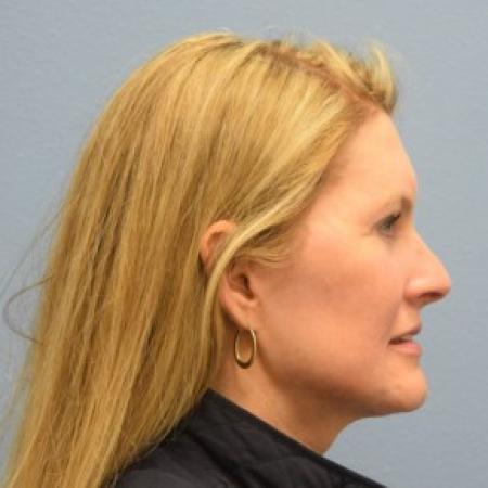 After image 3 Case #86146 - Minimal Access Cranial Suspension (MACS) Lift