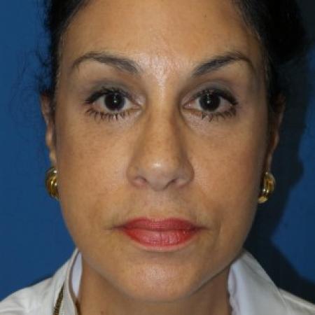 After image 1 Case #86611 - Facelift/Lower Blepharoplasty/Browlift     3 months post-op