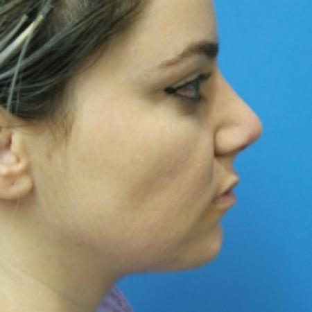 After image 1 Case #86936 - 29 year old  -  Rhinoplasty/Chin Augmentation/Submental Liposuction to Neck  -  2 months post-op
