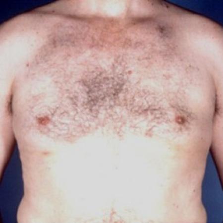 After image 1 Case #81516 - Gynecomastia