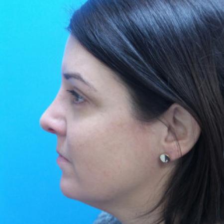 After image 3 Case #88206 - 40 year old  -  Rhinoplasty & Septoplasty  -  1 month post-op