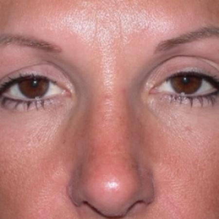After image 1 Case #79256 - Rhinoplasty