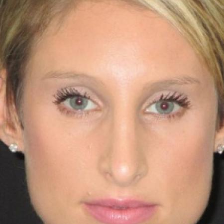 After image 1 Case #82791 - Septorhinoplasty