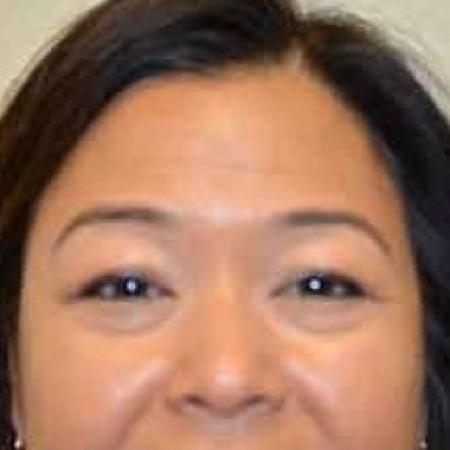 After image 1 Case #85766 - Botox 