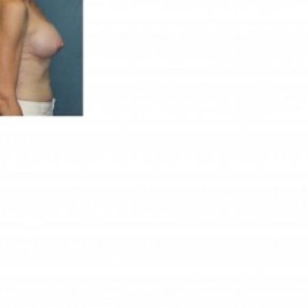 After image 2 Case #81266 - Breast Augmentation