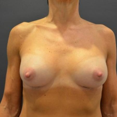 After image 1 Case #85781 - Breast Augmentation 