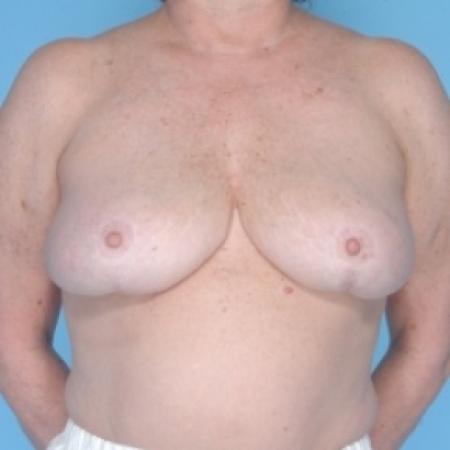After image 1 Case #79716 - Bilateral Breast Reduction 
