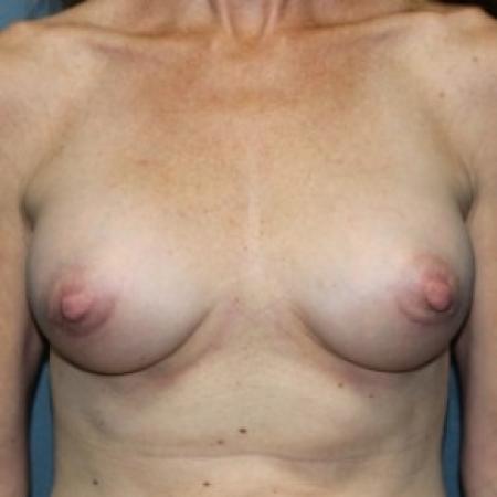 After image 1 Case #81266 - Breast Augmentation