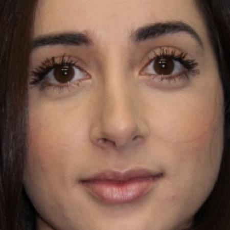 After image 1 Case #80826 - Rhinoplasty