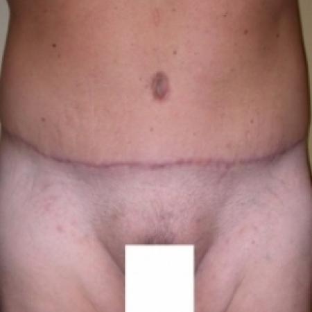 After image 1 Case #79796 - Male Tummy Tuck