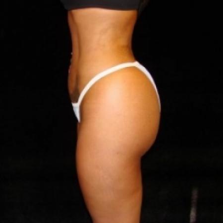 After image 3 Case #80481 - Buttocks Augmentation Via Fat Grafting with Lipsuction of Abdomen, Waist, Flanks, and Outer Thighs