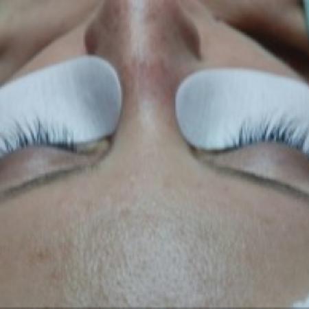 After Case #86386 - 38 year old woman treated with eyelash enhancement