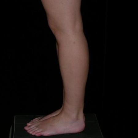After image 2 Case #81936 - Calf and Ankle Liposculpture