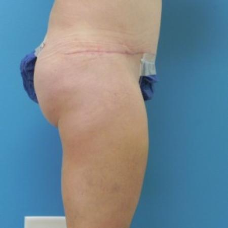 After image 2 Case #81851 - 41 Year Old Female Underwent Abdominoplasty