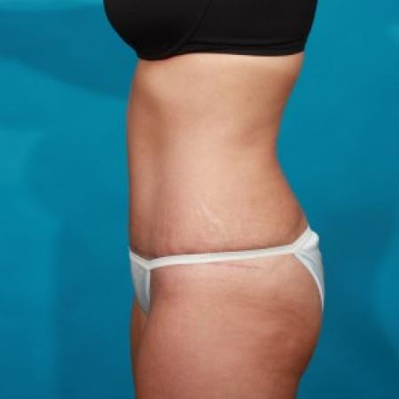 After image 3 Case #84071 - Abdominoplasty with Flank Lipo