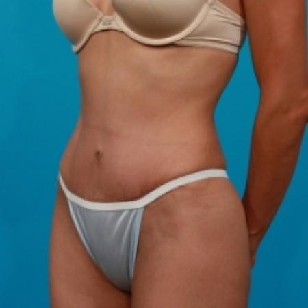 After image 2 Case #78906 - Tummy Tuck