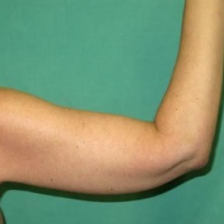 After image 2 Case #85666 - Upper Arm Lift 
