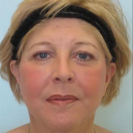 After image 1 Case #82696 - 53 Year Old Woman's Facial Rejuvenation