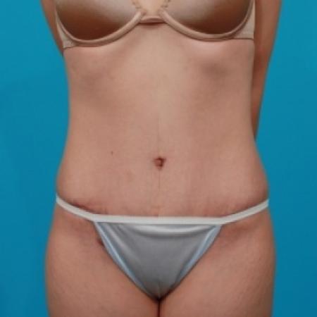 After image 1 Case #78881 - Tummy Tuck