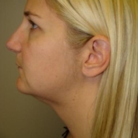 After image 1 Case #79611 - Submentoplasty